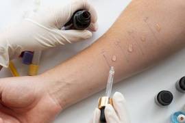 Food Allergy Treatment, United States, 77030