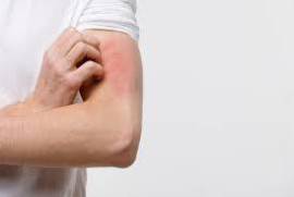 Update Treatment in Allergy, United States, 77030
