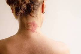 Allergic Inflammation, United States, 77090