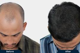 HairFree and HairGrow Clinic - Silvassa, India, 396230