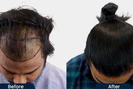 HairFree and HairGrow Clinic - Gurugram, India, 122003