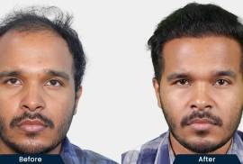 HairFree and HairGrow Clinic - Vapi, India, 396191