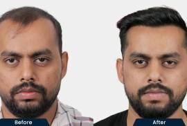 HairFree and HairGrow Clinic - Banglore, India, 560095