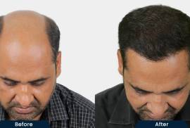 HairFree and HairGrow Clinic - Kharadi, India, 411014