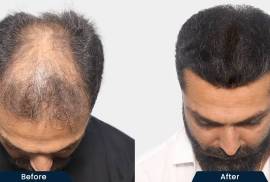 HairFree and HairGrow Clinic - Kolkata, India, 700156
